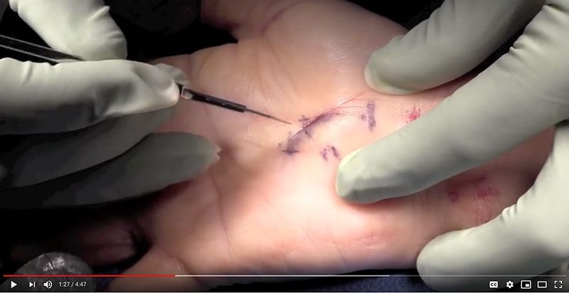 Video of carpal tunnel surgery